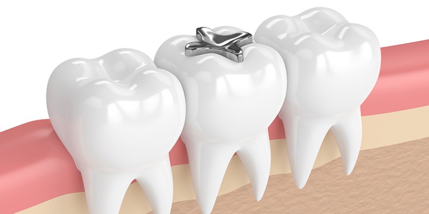 Dişlerinizdeki ‘gümüş dolgular’ ne kadar güvenilir?
