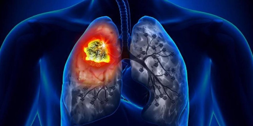 Akciğer kanseri en çok erkeklerde görülüyor