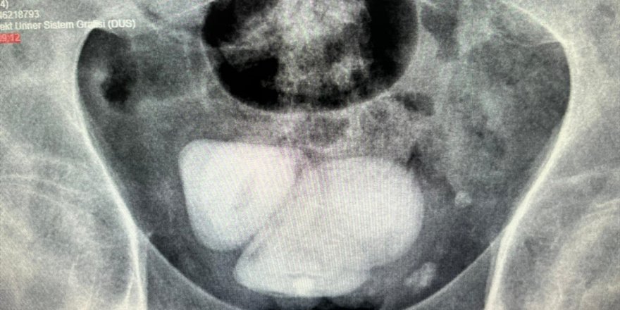Aydın'da hastanın mesanesinden piramit şeklinde taşlar çıkarıldı