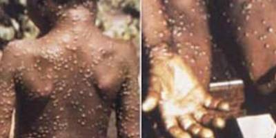 Birleşik Krallık'ta 2 kişide "maymun çiçeği virüsü" görüldü