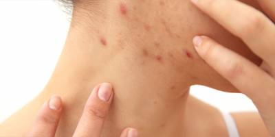 İzmir'de 'uyuz salgını' iddiası!