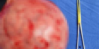 Tıpta nadir durum: Karnından 20 santim büyüklüğünde miyom çıktı