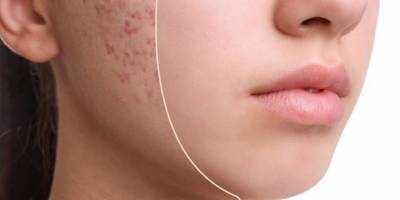 Paket yiyecekler, doymuş yağ ve aşırı süt tüketimi akne oluşumunu tetikliyor