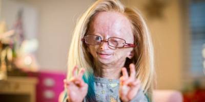 'Benjamin Button Hastalığı' ile mücadele Eden ünlü YouTuber Adalia Rose hayatını kaybetti