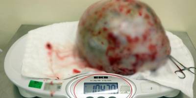 Karnından 10,5 kilo kitle çıkarılan genç kadın konuştu