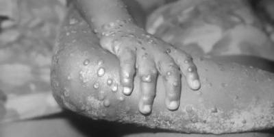 Maymun çiçeği virüsü hızla yayılıyor: Kanada, Avustralya ve Avrupa'da yeni vakalar