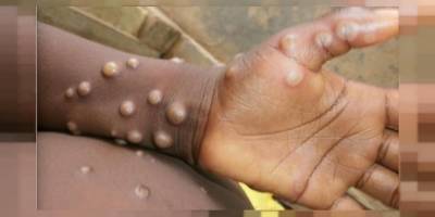 Maymun çiçeği virüsü İsviçre'ye sıçradı