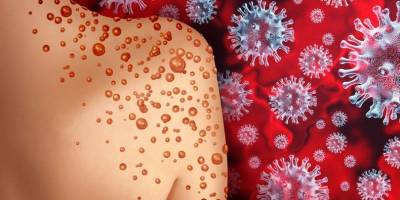 Meksika’da maymun çiçeği hastası ABD'li hastaneden kaçtı