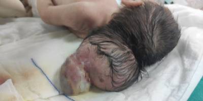 Beyninin yarısı kafatası dışında dünyaya geldi