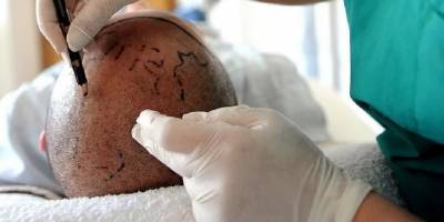 2022'de 1 milyon kişi Türkiye'ye saç ektirmeye geldi