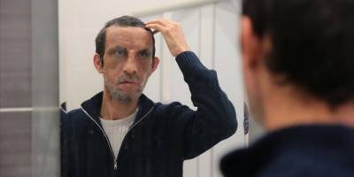 Uğur Acar 11 yıldır yeni yüzüyle aynalarla barışık yaşıyor