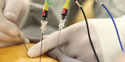 Radyofrekans yöntemiyle kılcal damarları acısız ve ağrısız tedavi imkanı