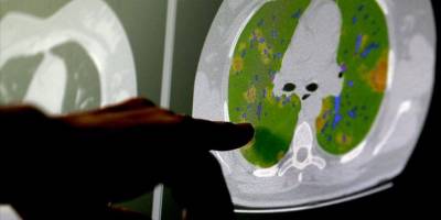 Kovid-19 virüsünün beyin hücreleriyle birleşebildiği kanıtlandı