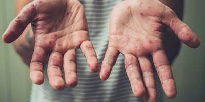 İstanbul'da kızamık alarmı: İTO 'endişe verici' uyarısı yaptı