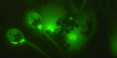 Doktorlar dehşete düştü: Dünyada ilk kez bir kadının beyninde 'canlı parazit solucan' bulundu